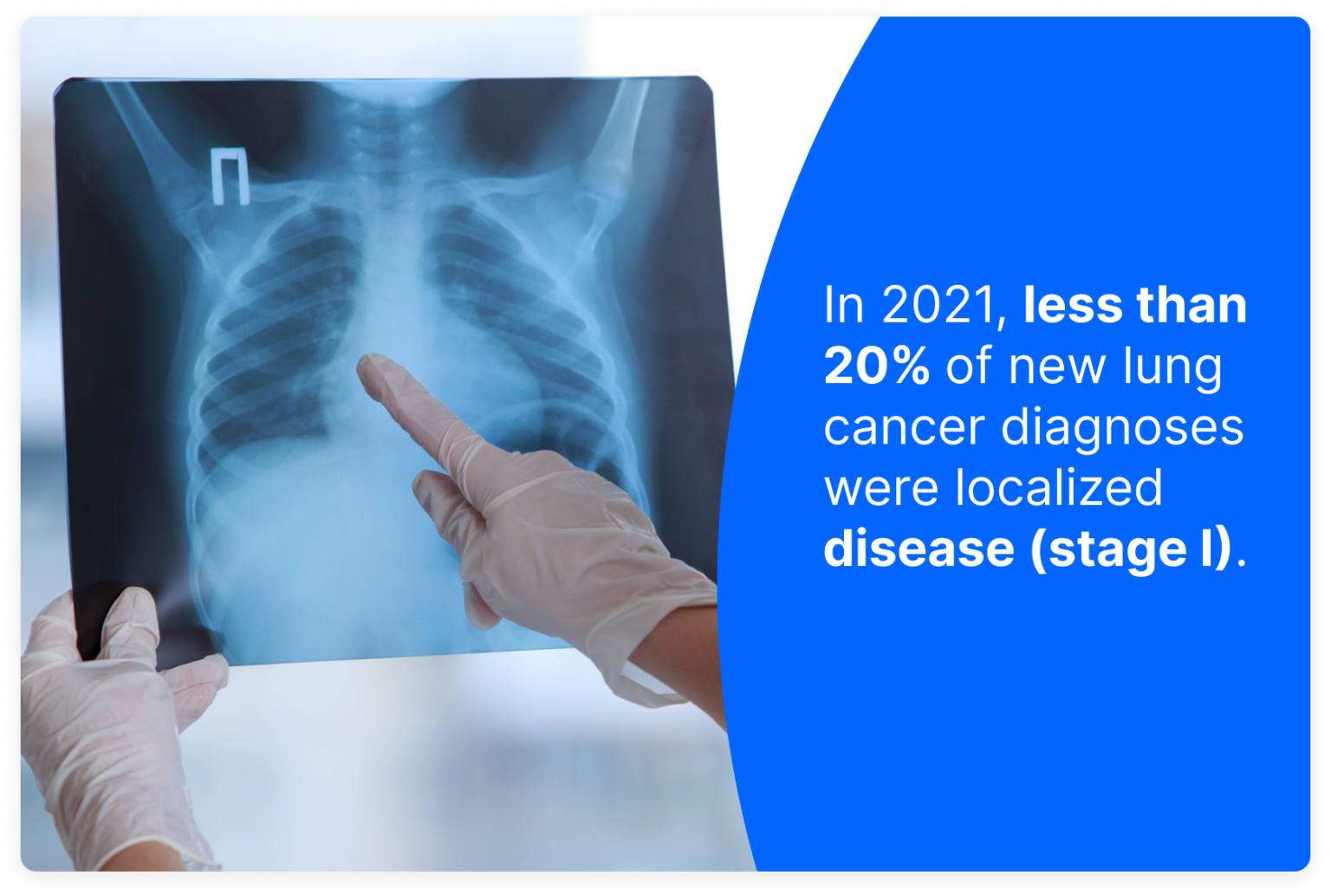 lung-cancer-imaging-why-low-dose-ct-is-the-way-to-go-pockethealth