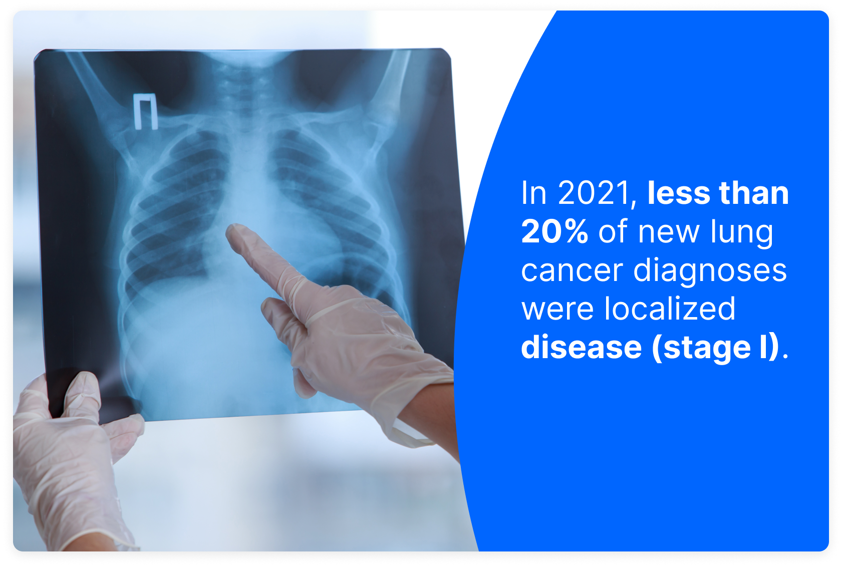 Lung Cancer Imaging Why Low Dose Ct Is The Way To Go Pockethealth 8646