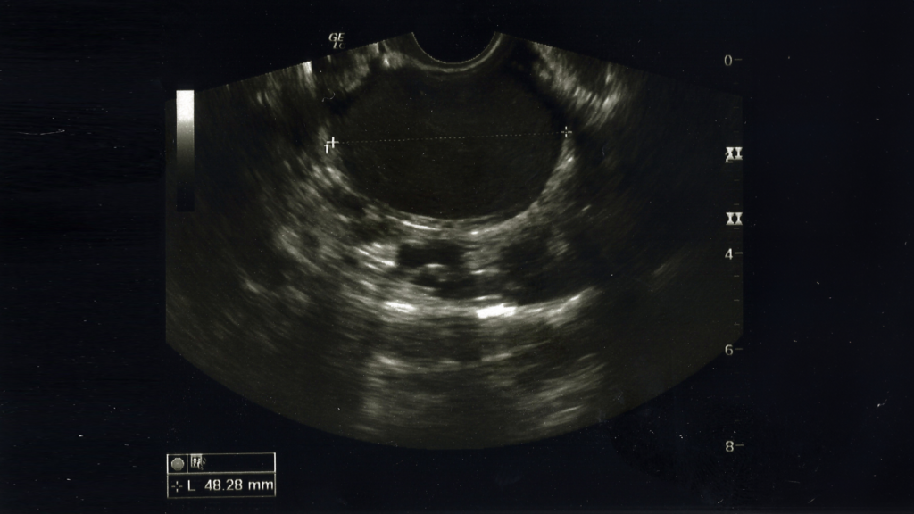 Uterine endometriosis on an ultrasound