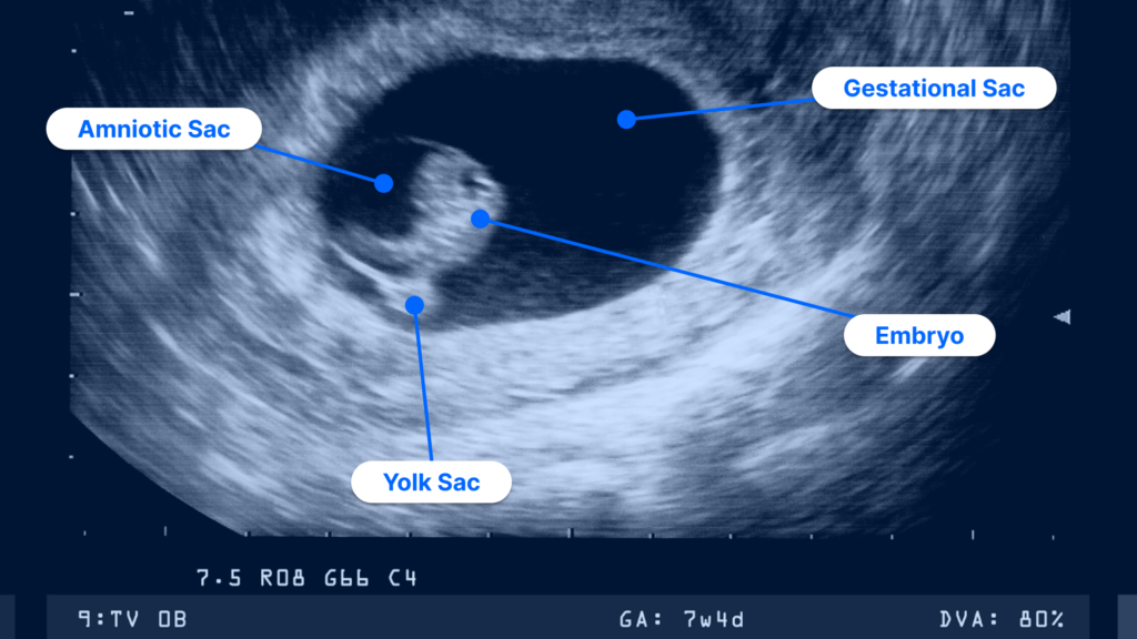 7-weeks-pregnant-ultrasound-pockethealth