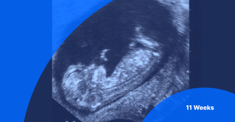 11-week-ultrasound-pictures-fetus-size-what-to-expect