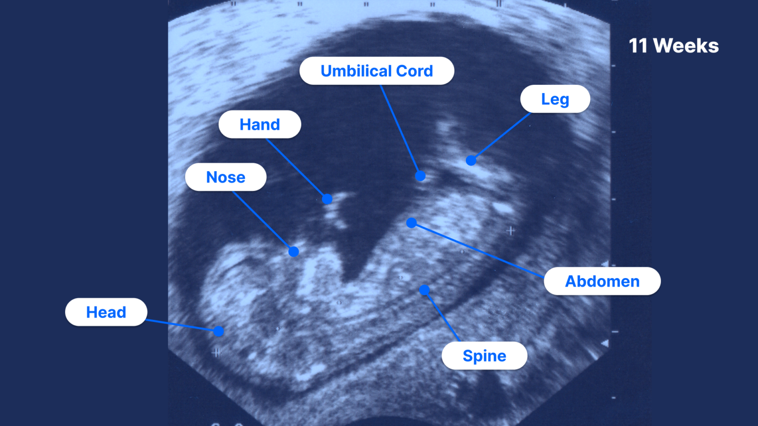 11 Weeks Pregnant Ultrasound Pockethealth 