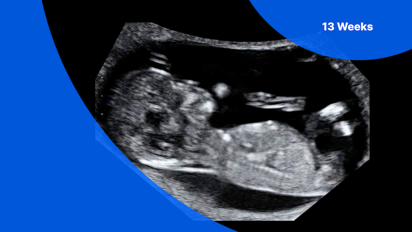 13 Week Ultrasound Pictures Gender Prediction And Baby s Growth