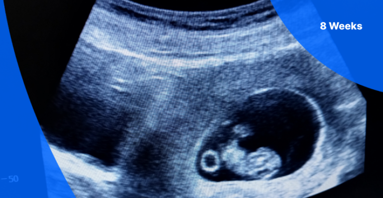 8-week-ultrasound-pictures-fetus-size-twins-and-more