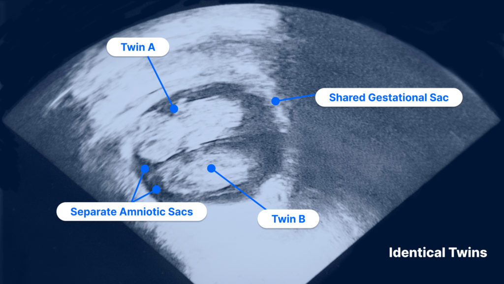 weeks ultrasound twin