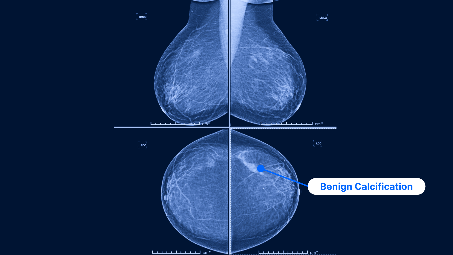 Mammogram Guide to Breast Cancer Screening | PocketHealth