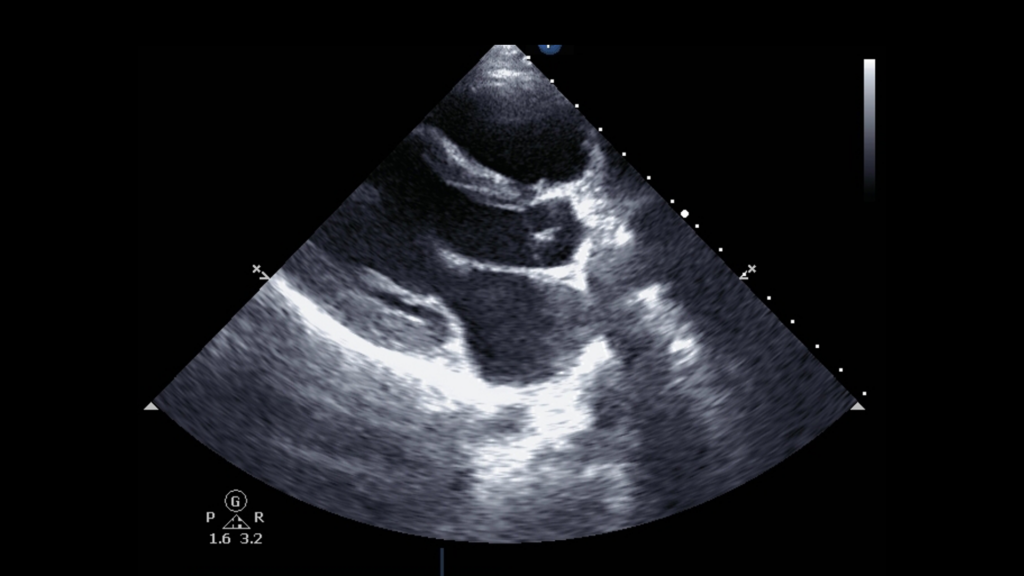 Transthoracic echocardiogram