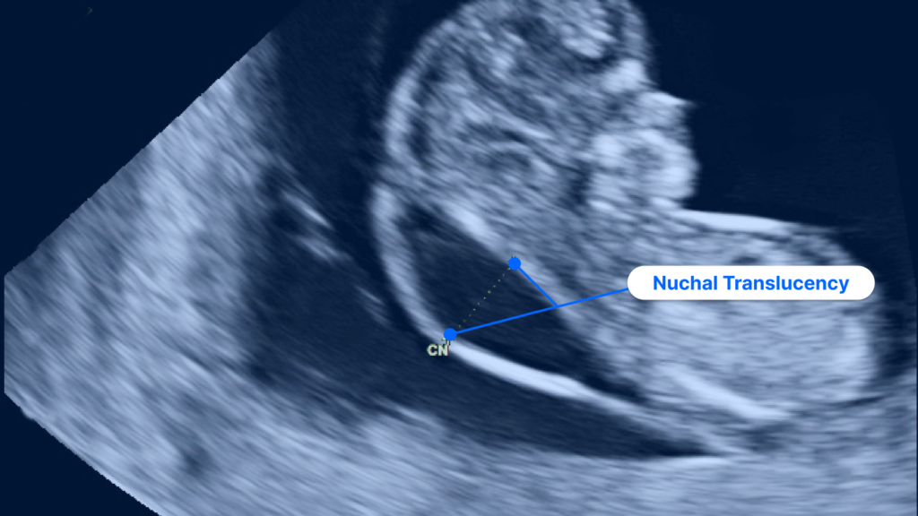 Nuchal Translucency Ultrasound (NT Scan): Test Results and More